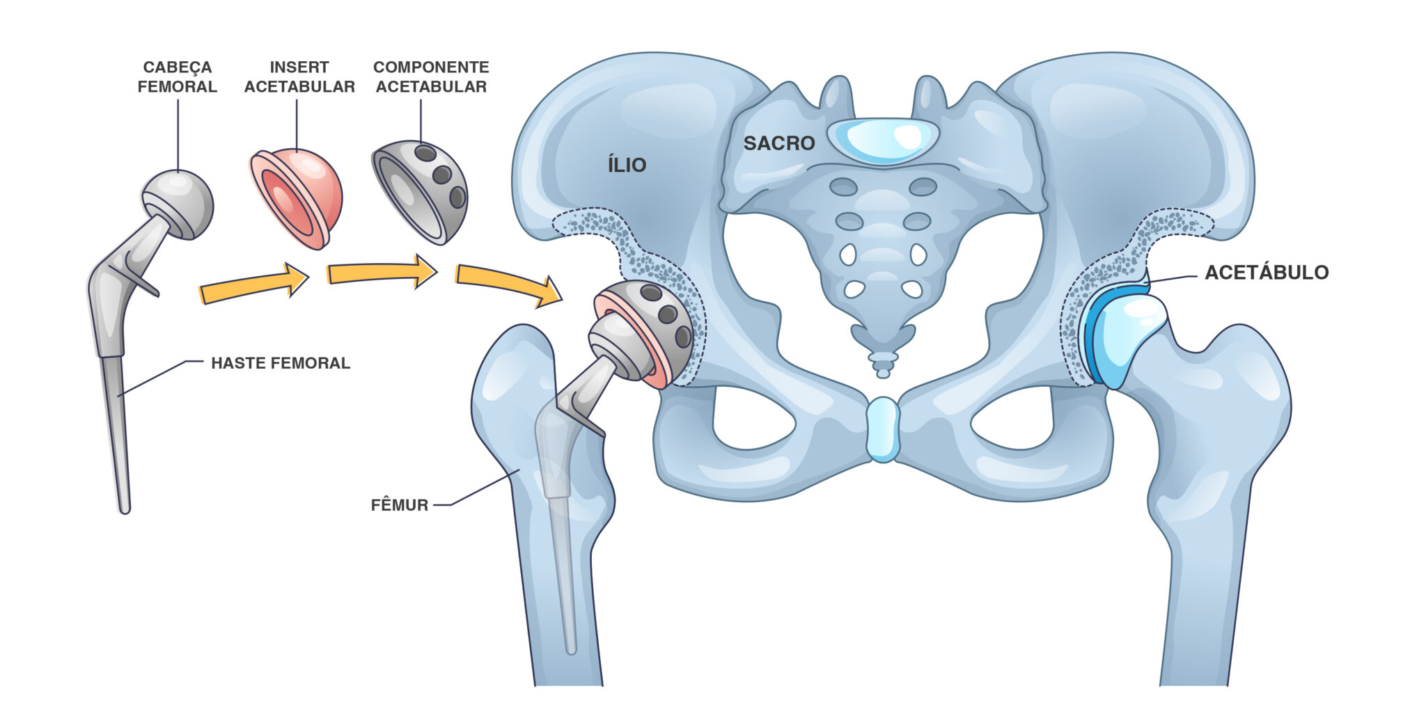 Pr Tese De Quadril Cirurgia De Quadril